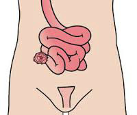 Afbeelding: van darmen met stoma.